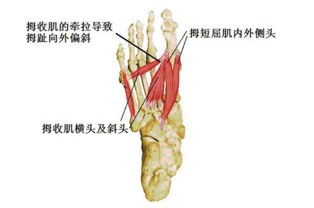 踇趾长期处于外偏,第一跖趾关节内侧关节囊及关节侧副韧带变得